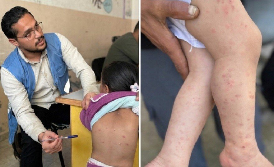 “أونروا” : أكثر من 125 ألف إصابة جلدية مرتبطة بالقوارض والطفيليات في غزة